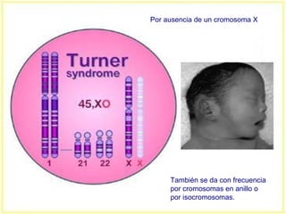 También se da con frecuencia
por cromosomas en anillo o
por isocromosomas.
Por ausencia de un cromosoma X
 