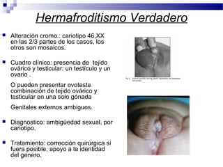 Hermafroditismo Verdadero
 Alteración cromo.: cariotipo 46,XX
en las 2/3 partes de los casos, los
otros son mosaicos.
 Cuadro clínico: presencia de tejido
ovárico y testicular: un testículo y un
ovario .
O pueden presentar ovoteste
combinación de tejido ovárico y
testicular en una solo gónada
Genitales externos ambiguos.
 Diagnostico: ambigüedad sexual, por
cariotipo.
 Tratamiento: corrección quirúrgica si
fuera posible, apoyo a la identidad
del genero.
 