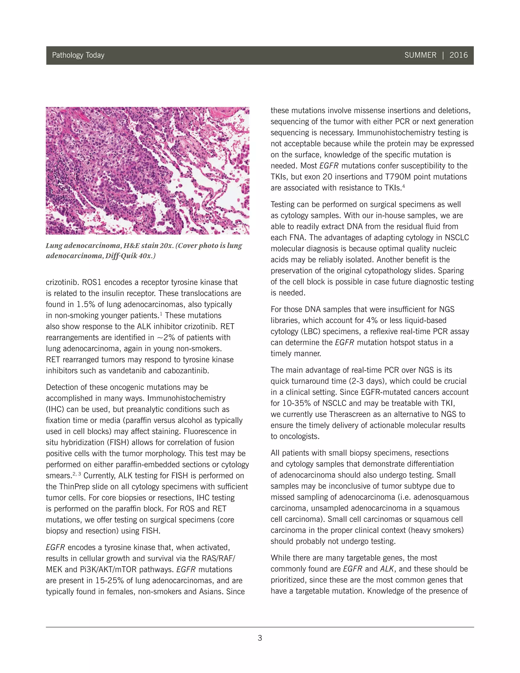 3
Pathology Today SUMMER | 2016
crizotinib. ROS1 encodes a receptor tyrosine kinase that
is related to the insulin receptor. These translocations are
found in 1.5% of lung adenocarcinomas, also typically
in non-smoking younger patients.1
These mutations
also show response to the ALK inhibitor crizotinib. RET
rearrangements are identified in ~2% of patients with
lung adenocarcinoma, again in young non-smokers.
RET rearranged tumors may respond to tyrosine kinase
inhibitors such as vandetanib and cabozantinib.
Detection of these oncogenic mutations may be
accomplished in many ways. Immunohistochemistry
(IHC) can be used, but preanalytic conditions such as
fixation time or media (paraffin versus alcohol as typically
used in cell blocks) may affect staining. Fluorescence in
situ hybridization (FISH) allows for correlation of fusion
positive cells with the tumor morphology. This test may be
performed on either paraffin-embedded sections or cytology
smears.2, 3
Currently, ALK testing for FISH is performed on
the ThinPrep slide on all cytology specimens with sufficient
tumor cells. For core biopsies or resections, IHC testing
is performed on the paraffin block. For ROS and RET
mutations, we offer testing on surgical specimens (core
biopsy and resection) using FISH.
EGFR encodes a tyrosine kinase that, when activated,
results in cellular growth and survival via the RAS/RAF/
MEK and Pi3K/AKT/mTOR pathways. EGFR mutations
are present in 15-25% of lung adenocarcinomas, and are
typically found in females, non-smokers and Asians. Since
these mutations involve missense insertions and deletions,
sequencing of the tumor with either PCR or next generation
sequencing is necessary. Immunohistochemistry testing is
not acceptable because while the protein may be expressed
on the surface, knowledge of the specific mutation is
needed. Most EGFR mutations confer susceptibility to the
TKIs, but exon 20 insertions and T790M point mutations
are associated with resistance to TKIs.4
Testing can be performed on surgical specimens as well
as cytology samples. With our in-house samples, we are
able to readily extract DNA from the residual fluid from
each FNA. The advantages of adapting cytology in NSCLC
molecular diagnosis is because optimal quality nucleic
acids may be reliably isolated. Another benefit is the
preservation of the original cytopathology slides. Sparing
of the cell block is possible in case future diagnostic testing
is needed.
For those DNA samples that were insufficient for NGS
libraries, which account for 4% or less liquid-based
cytology (LBC) specimens, a reflexive real-time PCR assay
can determine the EGFR mutation hotspot status in a
timely manner.
The main advantage of real-time PCR over NGS is its
quick turnaround time (2-3 days), which could be crucial
in a clinical setting. Since EGFR-mutated cancers account
for 10-35% of NSCLC and may be treatable with TKI,
we currently use Therascreen as an alternative to NGS to
ensure the timely delivery of actionable molecular results
to oncologists.
All patients with small biopsy specimens, resections
and cytology samples that demonstrate differentiation
of adenocarcinoma should also undergo testing. Small
samples may be inconclusive of tumor subtype due to
missed sampling of adenocarcinoma (i.e. adenosquamous
carcinoma, unsampled adenocarcinoma in a squamous
cell carcinoma). Small cell carcinomas or squamous cell
carcinoma in the proper clinical context (heavy smokers)
should probably not undergo testing.
While there are many targetable genes, the most
commonly found are EGFR and ALK, and these should be
prioritized, since these are the most common genes that
have a targetable mutation. Knowledge of the presence of
Lung adenocarcinoma, HE stain 20x. (Cover photo is lung
adenocarcinoma, Diff-Quik 40x.)
 