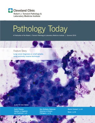 ALSO IN THIS ISSUE:
High Blood Pressure Prevention
Pathology Today
A Publication of the Robert J. Tomsich Pathology & Laboratory Medicine Institute | Summer 2016
Feature Story
Lung cancer diagnoses on small samples
using minimally invasive techniques
Cystic Fibrosis:
Updates in Diagnosis
and Treatment | p 6
New Multiplex Molecular
Detection of Enteric
Pathogens | p 10
Alumni Connect | p 14
News | p 16
 