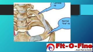 Cervical Rib | PPTX