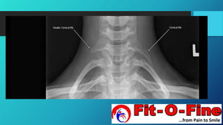 Cervical Rib | PPTX