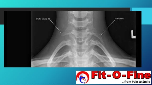 cervical rib