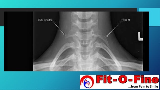 Cervical Rib