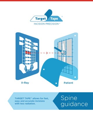 Spine
guidance
TARGET TAPE allows for fast,
easy and accurate incisions
with less radiation.
®
X-Ray Patient
INCISION PRECISION
®
TM
 