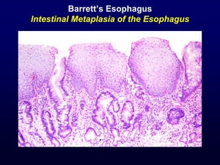 Barrett’s Esophagus
Intestinal Metaplasia of the Esophagus
 