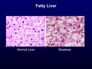 Fatty Liver
Normal Liver Steatosis
 