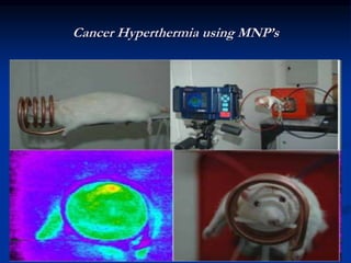 Cancer Hyperthermia using MNP’s
 