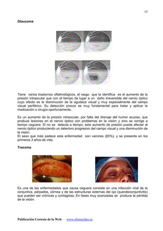 Publicación Cortesía de la Web: www.efemerides.ec
15
Glaucoma
Tiene varios trastornos oftalmológicos, el rasgo que la identifica es el aumento de la
presión intraocular que con el tiempo da lugar a un daño irreversible del nervio óptico
cuyo efecto es la disminución de la agudeza visual y muy especialmente del campo
visual periférico. Su detección precoz es muy fundamental para tratar y aplicar la
medicación o cirugía oportunamente.
Es un aumento de la presión intraocular, por falta del drenaje del humor acuoso, que
produce lesiones en el nervio óptico con problemas en la visión y sino se corrige a
tiempo ceguera. Si no se detecta a tiempo, este aumento de presión puede afectar al
nervio óptico produciendo un deterioro progresivo del campo visual y una disminución de
la visión.
El sexo que más padece esta enfermedad son varones (65%), y se presenta en los
primeros 3 años de vida.
Tracoma
Es una de las enfermedades que causa ceguera consiste en una infección viral de la
conjuntiva, párpados, córnea y de las estructuras externas del ojo (queratoconjuntivitis)
que pueden ser crónicas y contagiosa, En fases muy avanzadas se produce la pérdida
de la visión.
 
