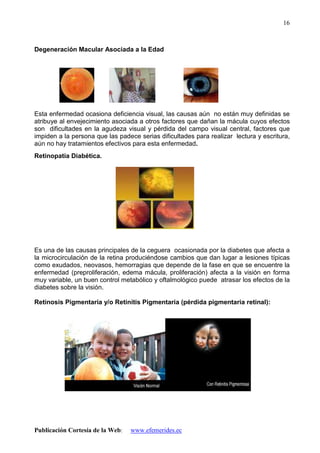 Publicación Cortesía de la Web: www.efemerides.ec
16
Degeneración Macular Asociada a la Edad
Esta enfermedad ocasiona deficiencia visual, las causas aún no están muy definidas se
atribuye al envejecimiento asociada a otros factores que dañan la mácula cuyos efectos
son dificultades en la agudeza visual y pérdida del campo visual central, factores que
impiden a la persona que las padece serias dificultades para realizar lectura y escritura,
aún no hay tratamientos efectivos para esta enfermedad.
Retinopatía Diabética.
Es una de las causas principales de la ceguera ocasionada por la diabetes que afecta a
la microcirculación de la retina produciéndose cambios que dan lugar a lesiones típicas
como exudados, neovasos, hemorragias que depende de la fase en que se encuentre la
enfermedad (preproliferación, edema mácula, proliferación) afecta a la visión en forma
muy variable, un buen control metabólico y oftalmológico puede atrasar los efectos de la
diabetes sobre la visión.
Retinosis Pigmentaria y/o Retinitis Pigmentaria (pérdida pigmentaria retinal):
 