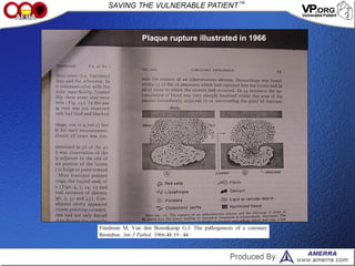 Plaque rupture illustrated in 1966
 