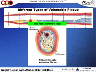 Naghavi et al. Circulation. 2003;108:1664
The most common type
 