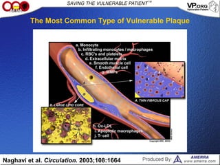Naghavi et al. Circulation. 2003;108:1664
The Most Common Type of Vulnerable Plaque
 