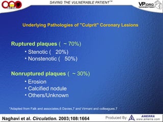 Underlying Pathologies of "Culprit" Coronary Lesions
Naghavi et al. Circulation. 2003;108:1664
Ruptured plaques ( ~ 70%)
• Stenotic ( 20%)
• Nonstenotic ( 50%)
Nonruptured plaques ( ~ 30%)
• Erosion
• Calcified nodule
• Others/Unknown
*Adapted from Falk and associates,6 Davies,7 and Virmani and colleagues.7
 