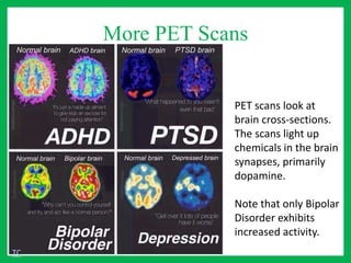 More PET Scans
PET scans look at
brain cross-sections.
The scans light up
chemicals in the brain
synapses, primarily
dopamine.
Note that only Bipolar
Disorder exhibits
increased activity.
TC
 