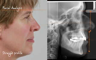 Facial Analysis
Straight profile
 