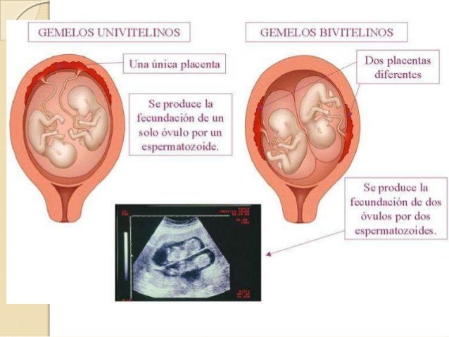 embarazo gemelar embarazo gemelar