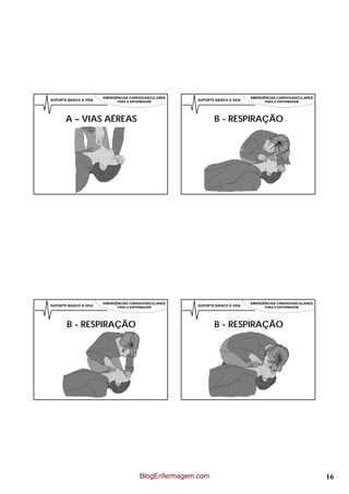 EMERGÊNCIAS CARDIOVASCULARES                            EMERGÊNCIAS CARDIOVASCULARES
SUPORTE BÁSICO À VIDA         PARA A ENFERMAGEM         SUPORTE BÁSICO À VIDA         PARA A ENFERMAGEM




       A – VIAS AÉREAS                                          B - RESPIRAÇÃO




                        EMERGÊNCIAS CARDIOVASCULARES                            EMERGÊNCIAS CARDIOVASCULARES
SUPORTE BÁSICO À VIDA         PARA A ENFERMAGEM         SUPORTE BÁSICO À VIDA         PARA A ENFERMAGEM




        B - RESPIRAÇÃO                                          B - RESPIRAÇÃO




                                         BlogEnfermagem.com                                                    16
 