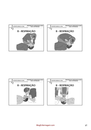 EMERGÊNCIAS CARDIOVASCULARES                            EMERGÊNCIAS CARDIOVASCULARES
SUPORTE BÁSICO À VIDA         PARA A ENFERMAGEM         SUPORTE BÁSICO À VIDA         PARA A ENFERMAGEM




        B - RESPIRAÇÃO                                          B - RESPIRAÇÃO




                        EMERGÊNCIAS CARDIOVASCULARES                            EMERGÊNCIAS CARDIOVASCULARES
SUPORTE BÁSICO À VIDA         PARA A ENFERMAGEM         SUPORTE BÁSICO À VIDA         PARA A ENFERMAGEM




        B - RESPIRAÇÃO                                          B - RESPIRAÇÃO




                                         BlogEnfermagem.com                                                    17
 