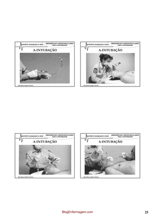 EMERGÊNCIAS CARDIOVASCULARES                                   EMERGÊNCIAS CARDIOVASCULARES
      SUPORTE AVANÇADO À VIDA         PARA A ENFERMAGEM              SUPORTE AVANÇADO À VIDA         PARA A ENFERMAGEM



                           A-INTUBAÇÃO                                                    A-INTUBAÇÃO




Enf. Álamo Araújo B. Pereira                                   Enf. Álamo Araújo B. Pereira




                                EMERGÊNCIAS CARDIOVASCULARES                                   EMERGÊNCIAS CARDIOVASCULARES
      SUPORTE AVANÇADO À VIDA         PARA A ENFERMAGEM              SUPORTE AVANÇADO À VIDA         PARA A ENFERMAGEM



                           A-INTUBAÇÃO                                                    A-INTUBAÇÃO




Enf. Álamo Araújo B. Pereira                                   Enf. Álamo Araújo B. Pereira




                                                 BlogEnfermagem.com                                                           25
 