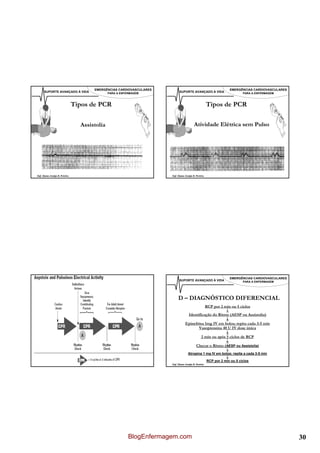 EMERGÊNCIAS CARDIOVASCULARES                                                 EMERGÊNCIAS CARDIOVASCULARES
      SUPORTE AVANÇADO À VIDA                 PARA A ENFERMAGEM            SUPORTE AVANÇADO À VIDA                       PARA A ENFERMAGEM



                               Tipos de PCR                                                         Tipos de PCR

                                 Assistolia                                             Atividade Elétrica sem Pulso




Enf. Álamo Araújo B. Pereira                                         Enf. Álamo Araújo B. Pereira




                                      EMERGÊNCIAS CARDIOVASCULARES                                                 EMERGÊNCIAS CARDIOVASCULARES
      SUPORTE AVANÇADO À VIDA                 PARA A ENFERMAGEM            SUPORTE AVANÇADO À VIDA                       PARA A ENFERMAGEM




                                                                          D – DIAGNÓSTICO DIFERENCIAL
                                                                                                    RCP por 2 min ou 5 ciclos
                                                                                                               ↓
                                                                                 Identificação do Rítmo (AESP ou Assistolia)
                                                                                                       ↓
                                                                                Epinefrina 1mg IV em bolos; repita cada 3-5 min
                                                                                       Vasopressina 40 U IV dose única
                                                                                                       ↓
                                                                                         2 min ou após 5 ciclos de RCP
                                                                                                       ↓
                                                                                     Checar o Rítmo (AESP ou Assistolia)
                                                                                                         ↓
                                                                                   Atropina 1 mg IV em bolos; repita a cada 3-5 min
                                                                                                         ↓
                                                                                              RCP por 2 min ou 5 ciclos
Enf. Álamo Araújo B. Pereira                                         Enf. Álamo Araújo B. Pereira




                                                         BlogEnfermagem.com                                                                       30
 