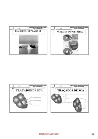 EMERGÊNCIAS CARDIOVASCULARES                EMERGÊNCIAS CARDIOVASCULARES
  SCA            PARA A ENFERMAGEM               SCA         PARA A ENFERMAGEM


IAM Q COM SUPRA DE ST                      PAREDES INFARTADAS




           EMERGÊNCIAS CARDIOVASCULARES                EMERGÊNCIAS CARDIOVASCULARES
  SCA            PARA A ENFERMAGEM               SCA         PARA A ENFERMAGEM




TRAÇADOS DE SCA                             TRAÇADOS DE SCA




                            BlogEnfermagem.com                                        34
 