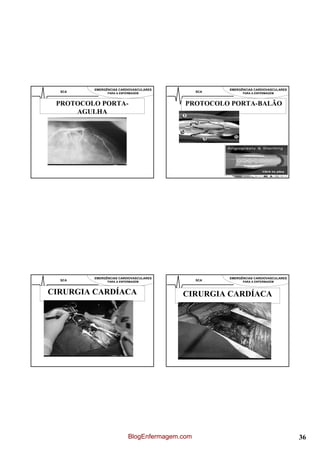EMERGÊNCIAS CARDIOVASCULARES                EMERGÊNCIAS CARDIOVASCULARES
  SCA          PARA A ENFERMAGEM               SCA         PARA A ENFERMAGEM



 PROTOCOLO PORTA-                         PROTOCOLO PORTA-BALÃO
     AGULHA




         EMERGÊNCIAS CARDIOVASCULARES                EMERGÊNCIAS CARDIOVASCULARES
  SCA          PARA A ENFERMAGEM               SCA         PARA A ENFERMAGEM



CIRURGIA CARDÍACA                        CIRURGIA CARDÍACA




                          BlogEnfermagem.com                                        36
 