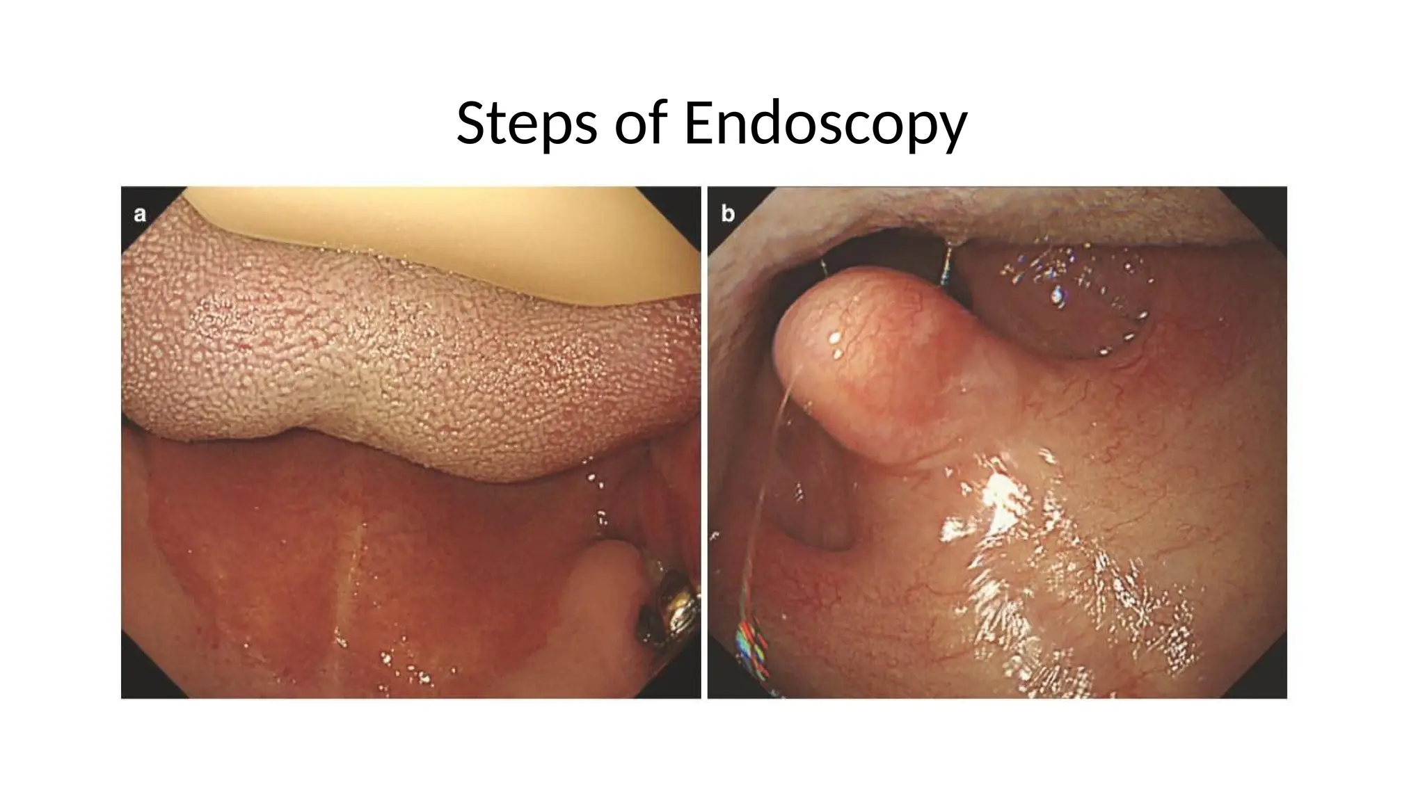 Steps of Endoscopy
 