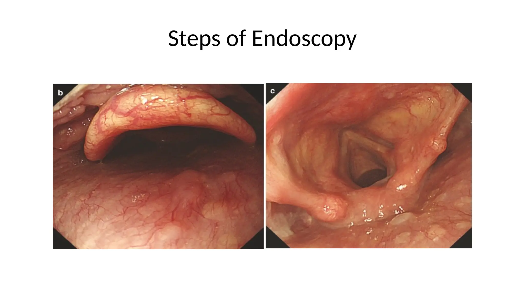 Steps of Endoscopy
 