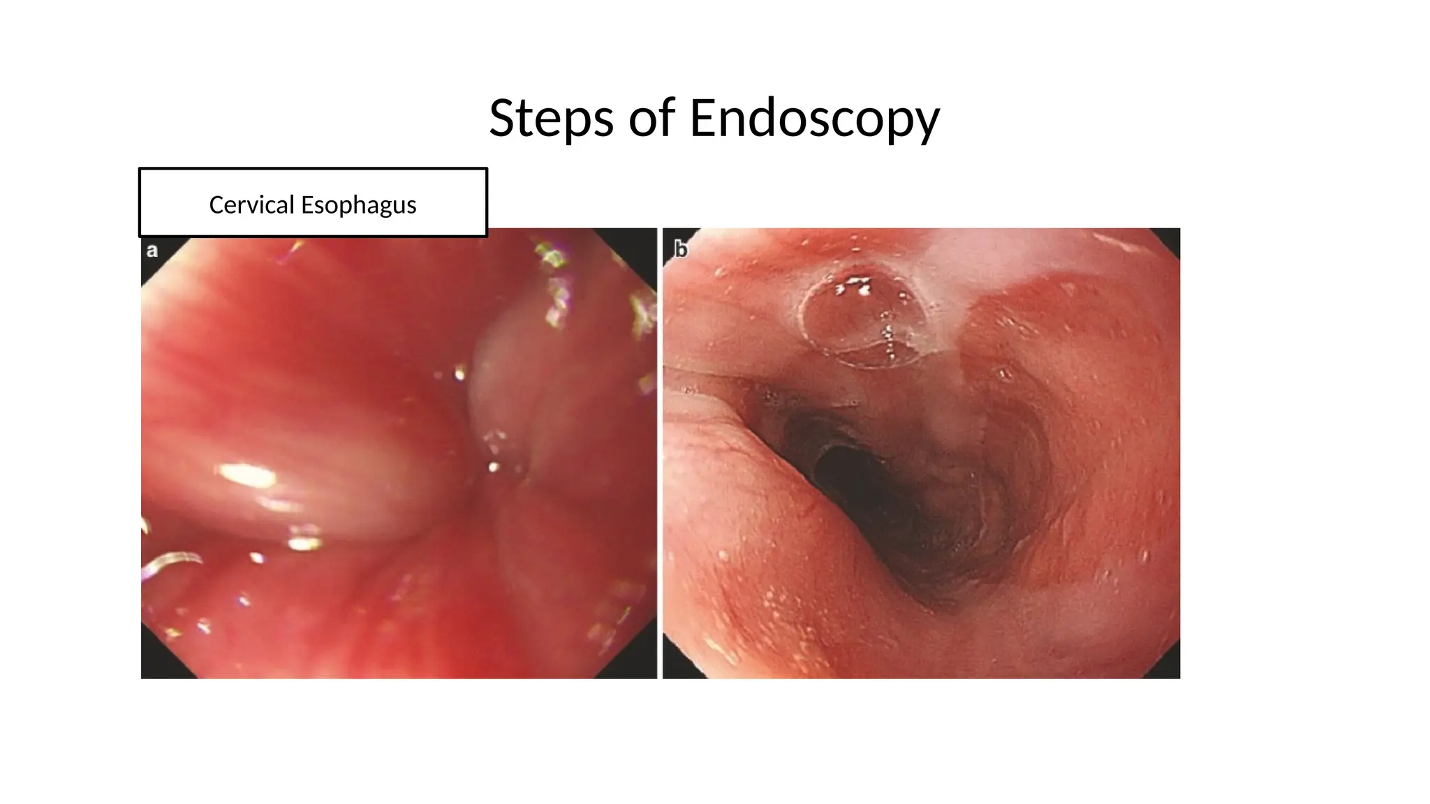Steps of Endoscopy
Cervical Esophagus
 