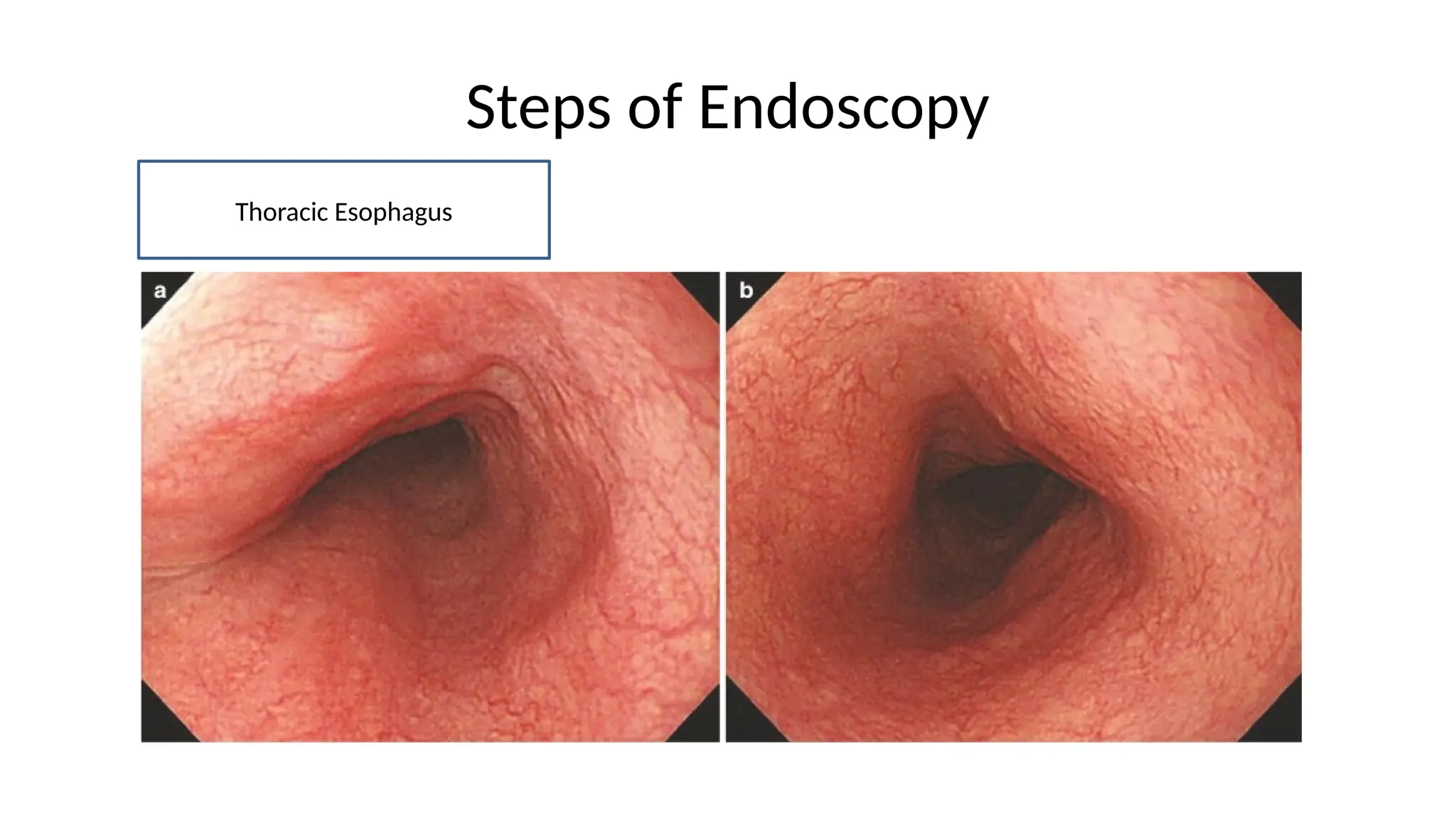 Steps of Endoscopy
Thoracic Esophagus
 