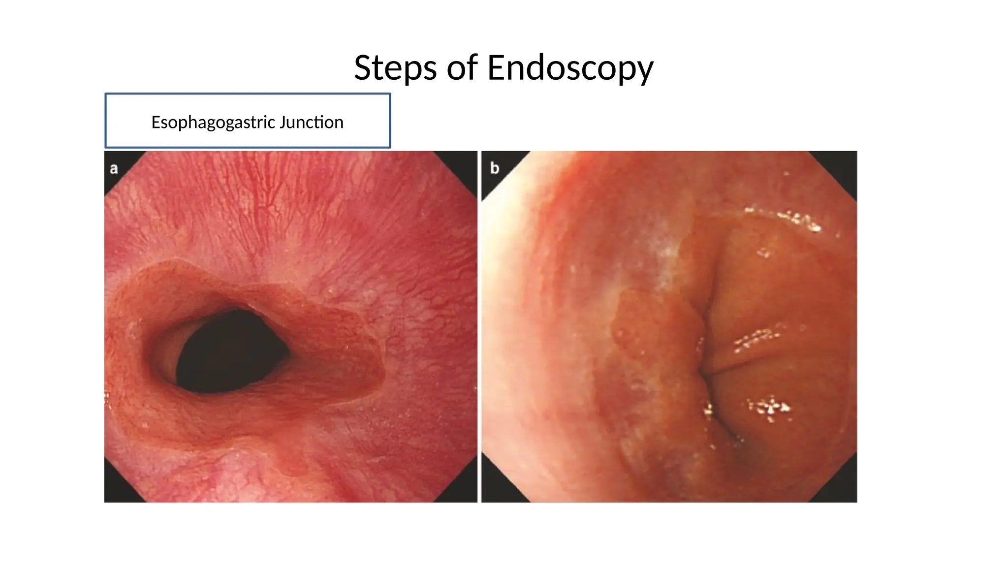 Steps of Endoscopy
Esophagogastric Junction
 