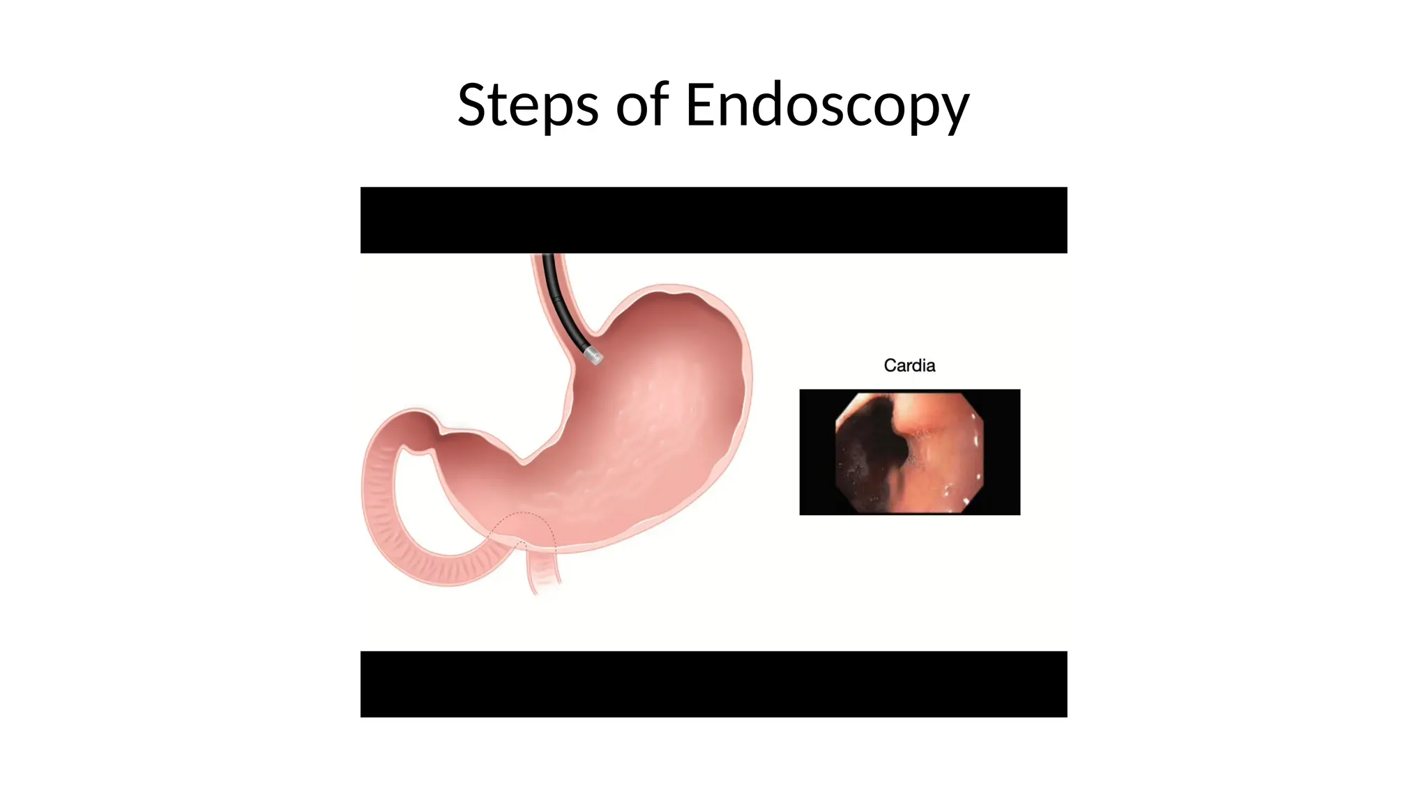 Steps of Endoscopy
 