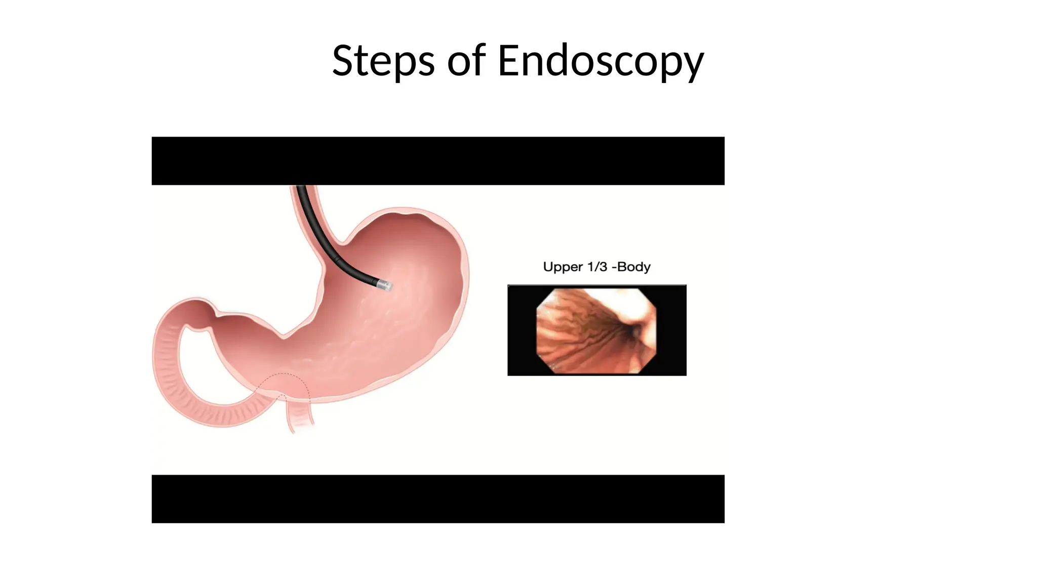 Steps of Endoscopy
 