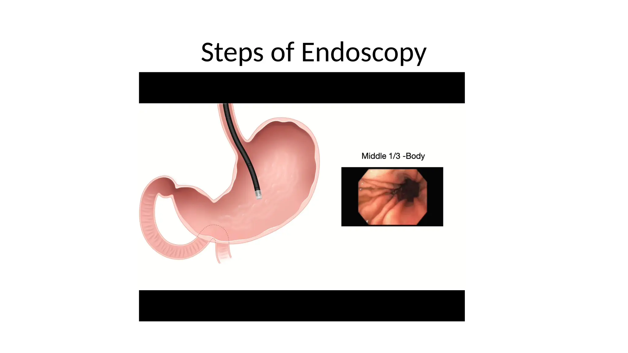 Steps of Endoscopy
 