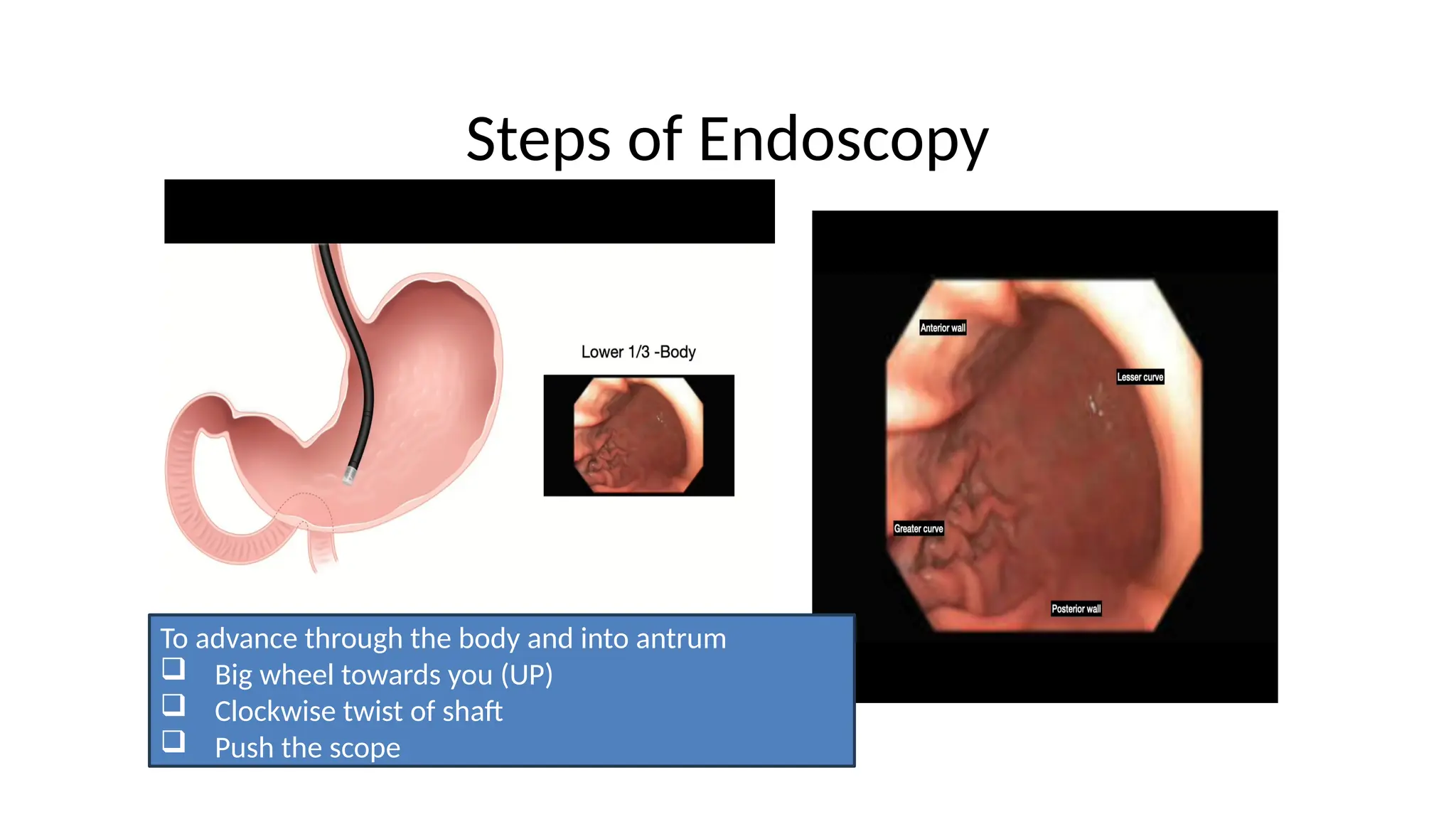 Steps of Endoscopy
To advance through the body and into antrum
 Big wheel towards you (UP)
 Clockwise twist of shaft
 Push the scope
 