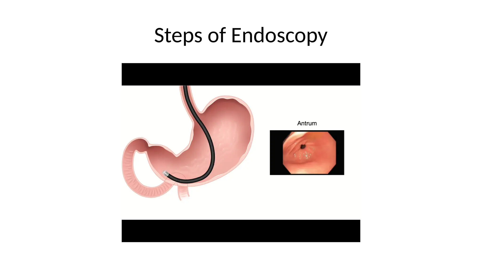 Steps of Endoscopy
 