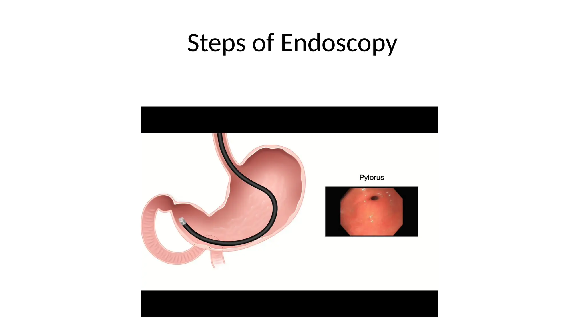 Steps of Endoscopy
 