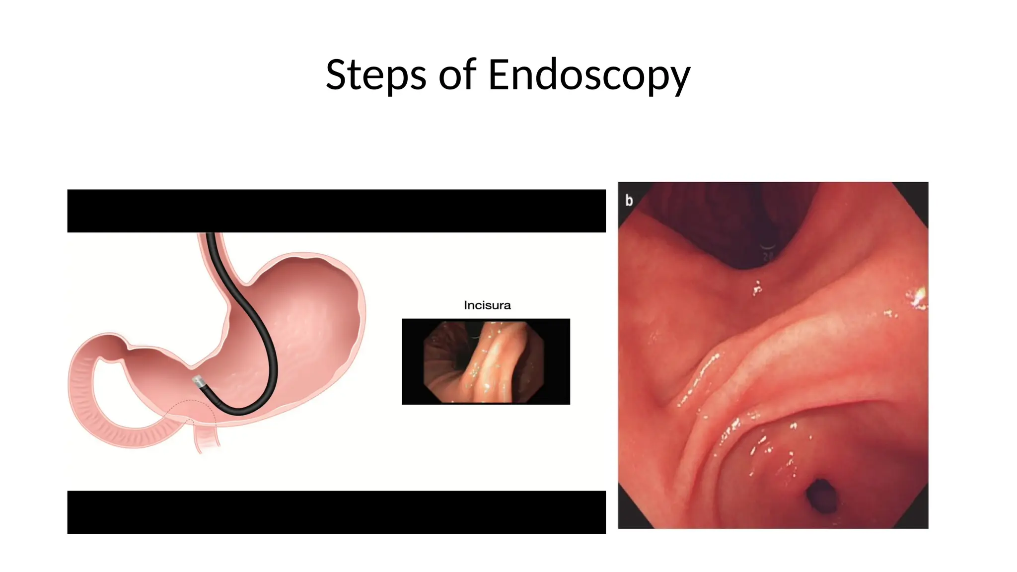 Steps of Endoscopy
 