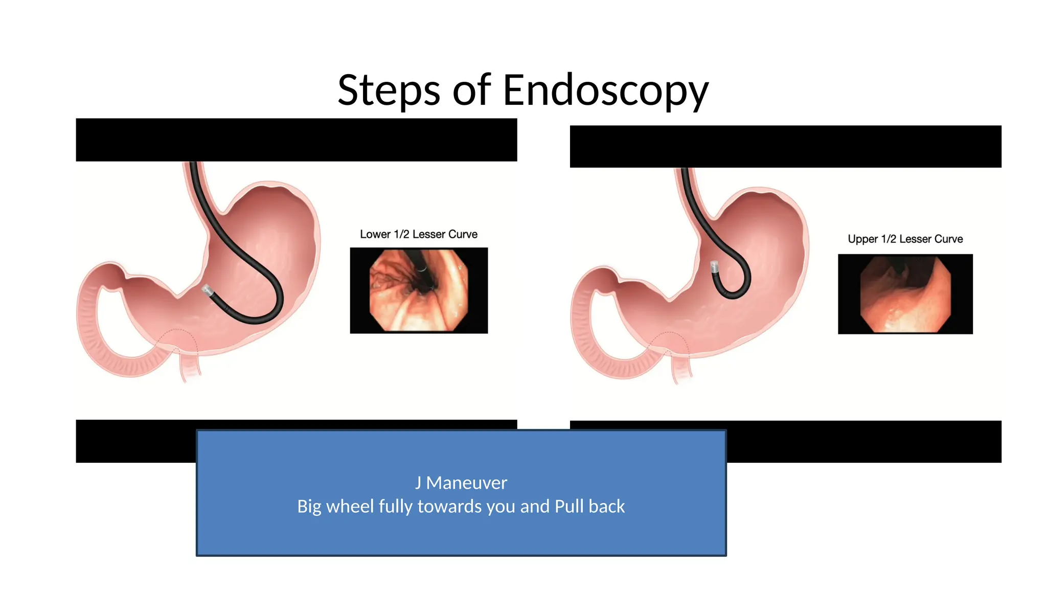 Steps of Endoscopy
J Maneuver
Big wheel fully towards you and Pull back
 