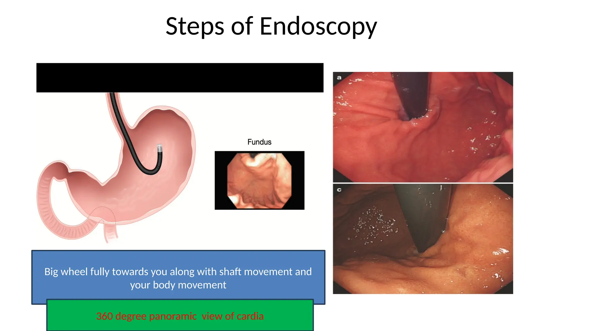 Steps of Endoscopy
Big wheel fully towards you along with shaft movement and
your body movement
360 degree panoramic view of cardia
 