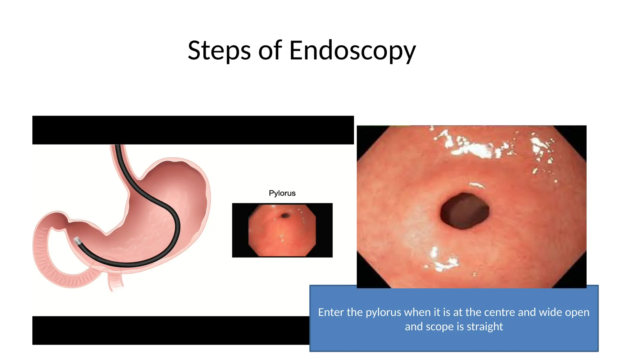 Steps of Endoscopy
Enter the pylorus when it is at the centre and wide open
and scope is straight
 