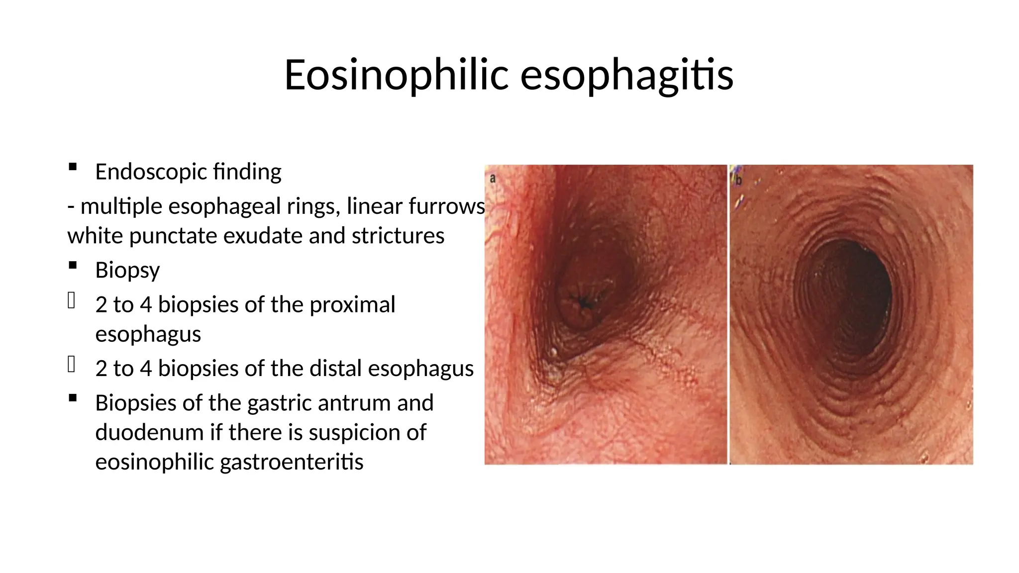 Eosinophilic esophagitis
 Endoscopic finding
- multiple esophageal rings, linear furrows,
white punctate exudate and strictures
 Biopsy
- 2 to 4 biopsies of the proximal
esophagus
- 2 to 4 biopsies of the distal esophagus
 Biopsies of the gastric antrum and
duodenum if there is suspicion of
eosinophilic gastroenteritis
 