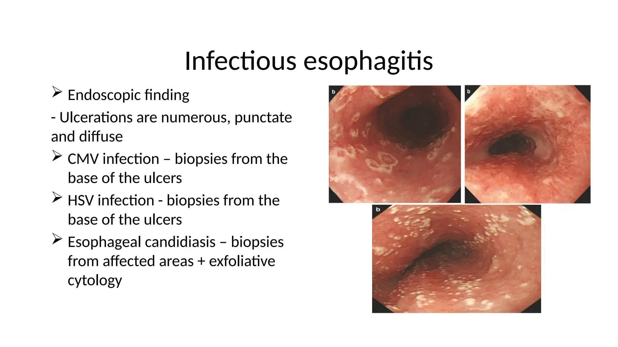 Infectious esophagitis
 Endoscopic finding
- Ulcerations are numerous, punctate
and diffuse
 CMV infection – biopsies from the
base of the ulcers
 HSV infection - biopsies from the
base of the ulcers
 Esophageal candidiasis – biopsies
from affected areas + exfoliative
cytology
 