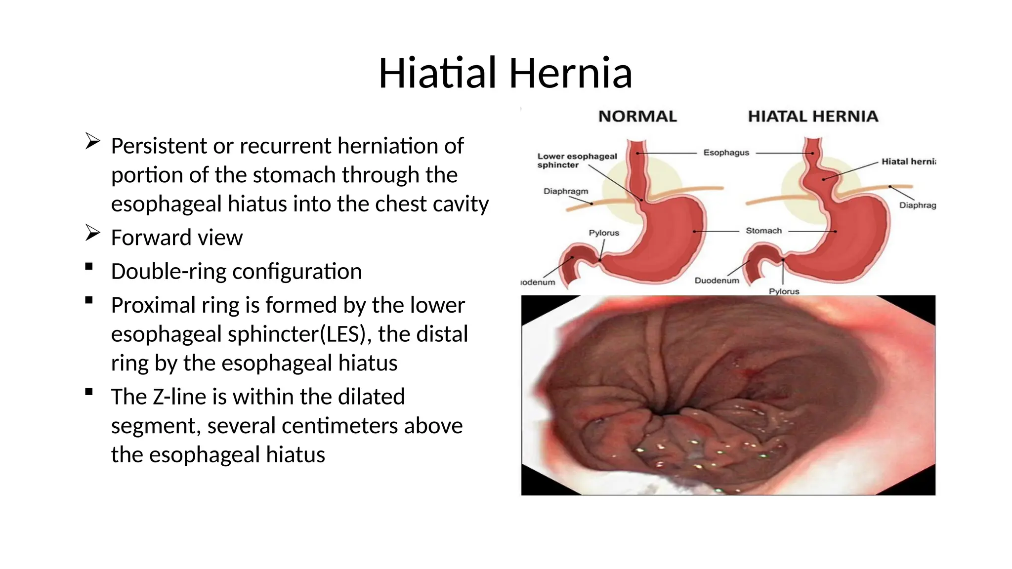 Hiatial Hernia
 Persistent or recurrent herniation of
portion of the stomach through the
esophageal hiatus into the chest cavity
 Forward view
 Double-ring configuration
 Proximal ring is formed by the lower
esophageal sphincter(LES), the distal
ring by the esophageal hiatus
 The Z-line is within the dilated
segment, several centimeters above
the esophageal hiatus
 