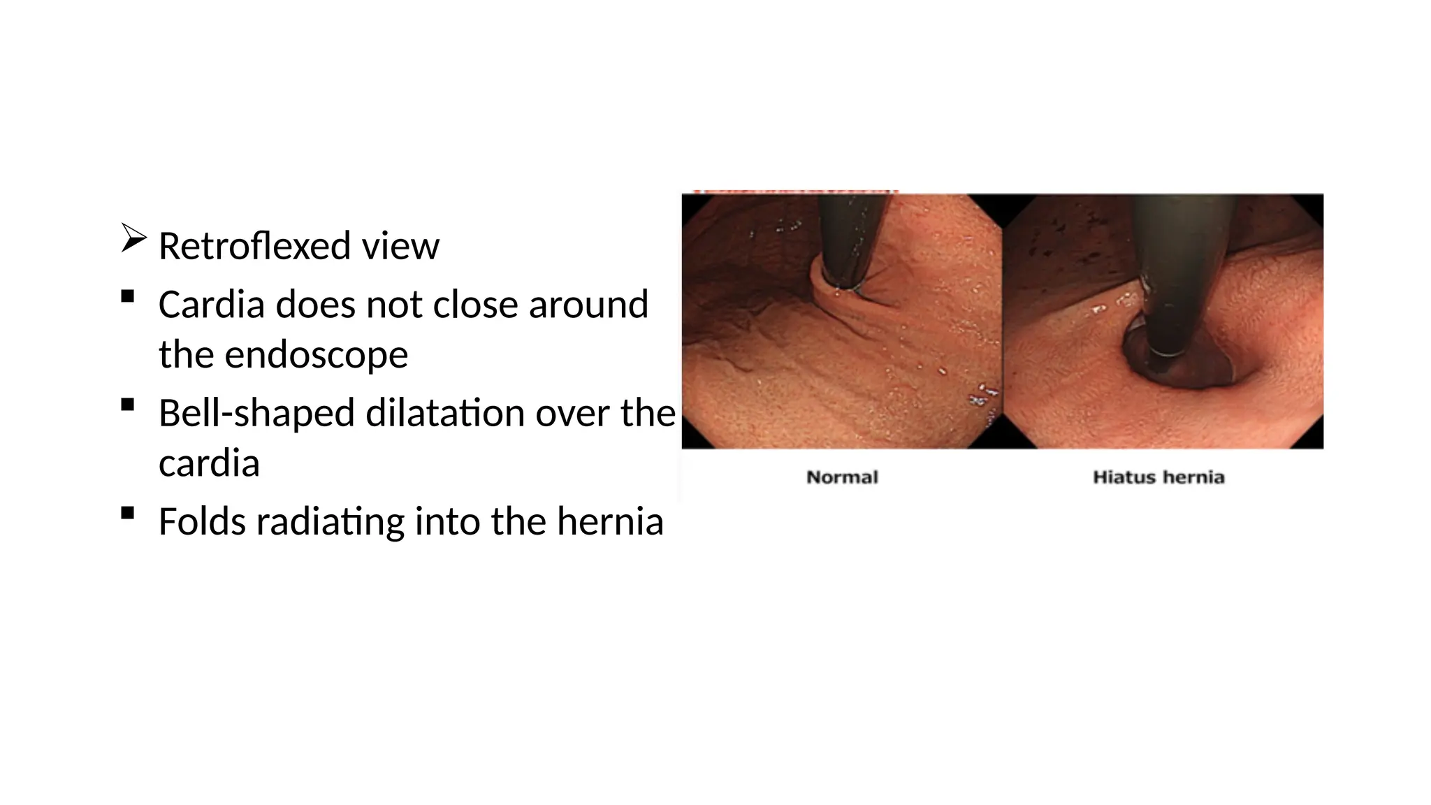  Retroflexed view
 Cardia does not close around
the endoscope
 Bell-shaped dilatation over the
cardia
 Folds radiating into the hernia
 