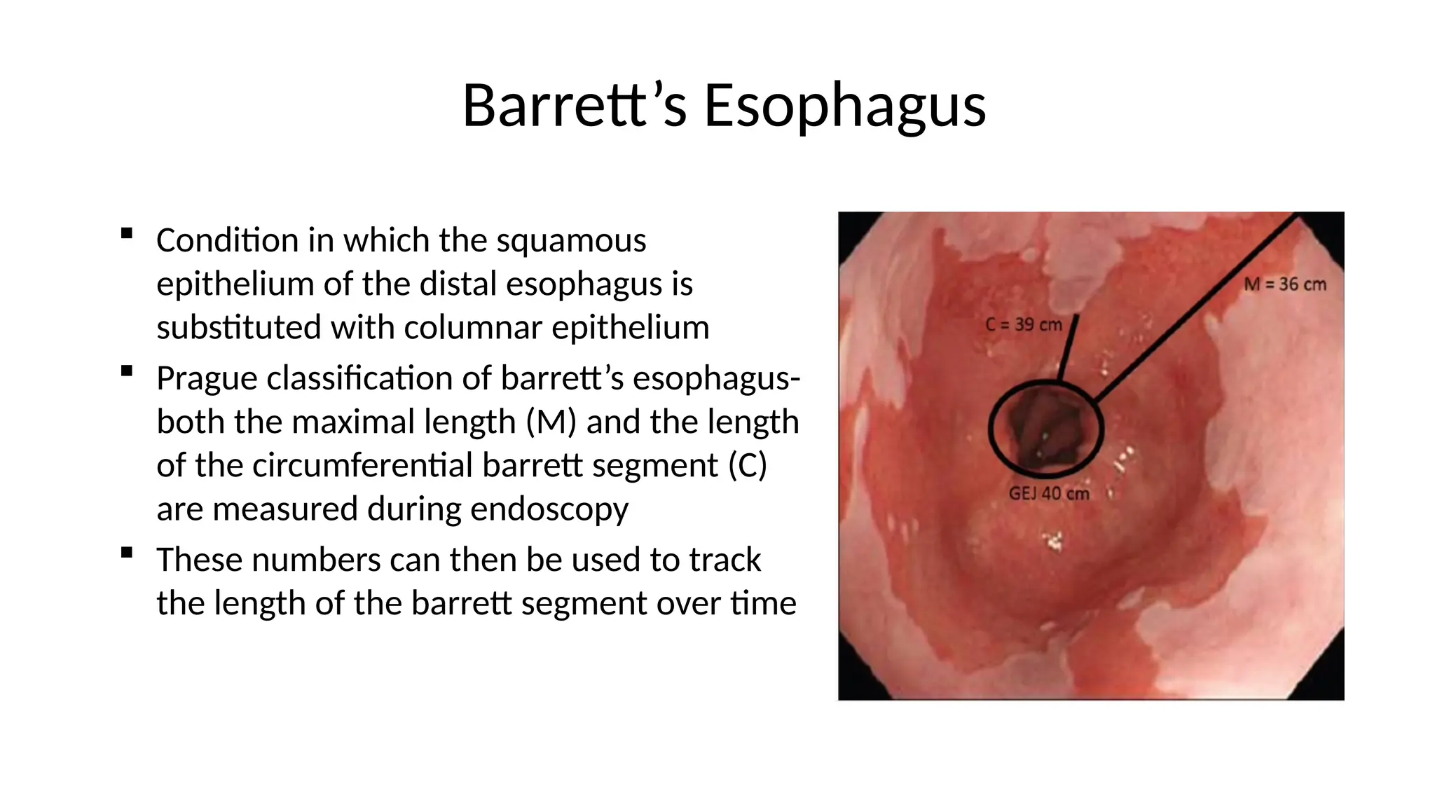 Barrett’s Esophagus
 Condition in which the squamous
epithelium of the distal esophagus is
substituted with columnar epithelium
 Prague classification of barrett’s esophagus-
both the maximal length (M) and the length
of the circumferential barrett segment (C)
are measured during endoscopy
 These numbers can then be used to track
the length of the barrett segment over time
 