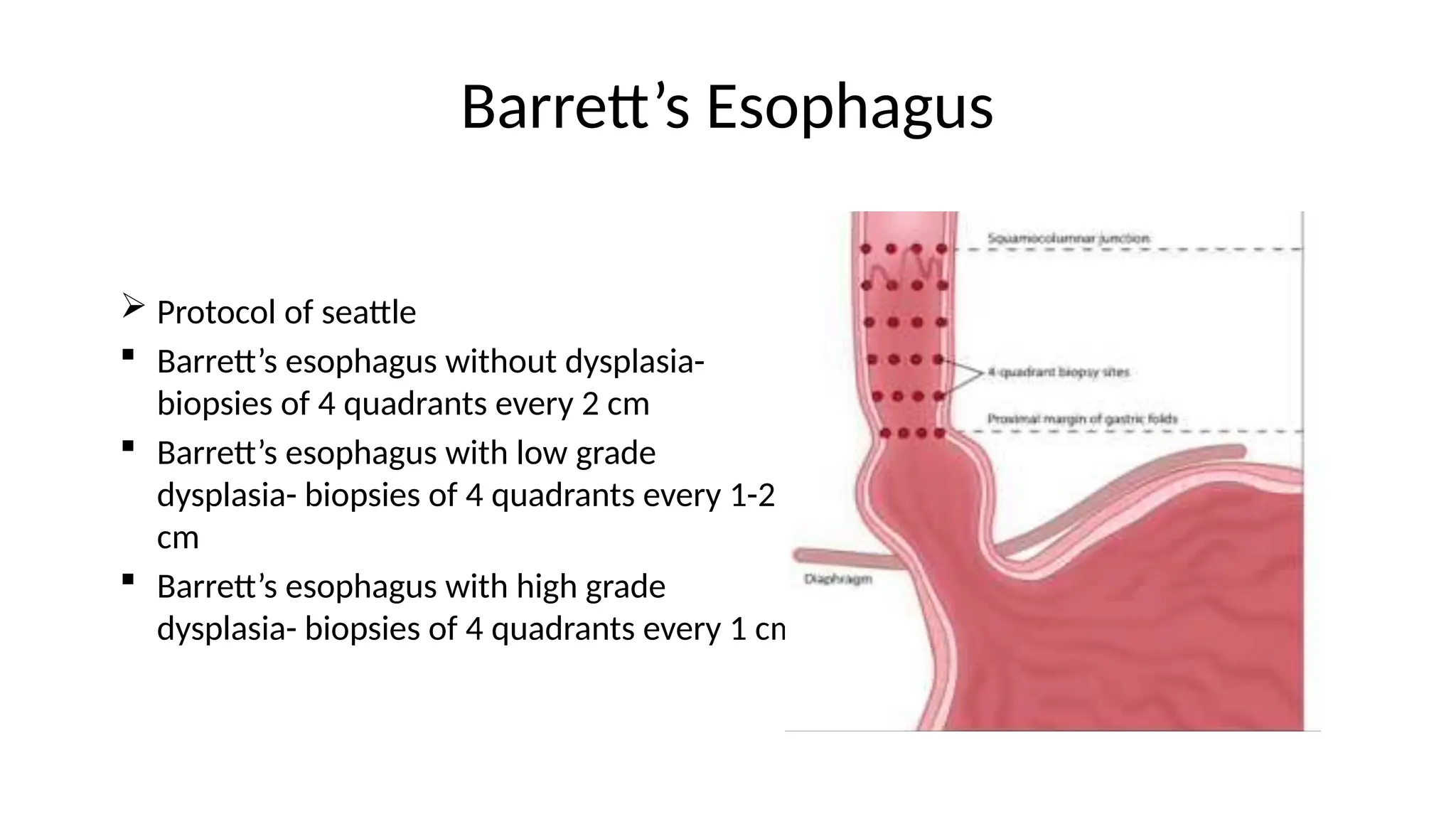 Barrett’s Esophagus
 Protocol of seattle
 Barrett’s esophagus without dysplasia-
biopsies of 4 quadrants every 2 cm
 Barrett’s esophagus with low grade
dysplasia- biopsies of 4 quadrants every 1-2
cm
 Barrett’s esophagus with high grade
dysplasia- biopsies of 4 quadrants every 1 cm
 