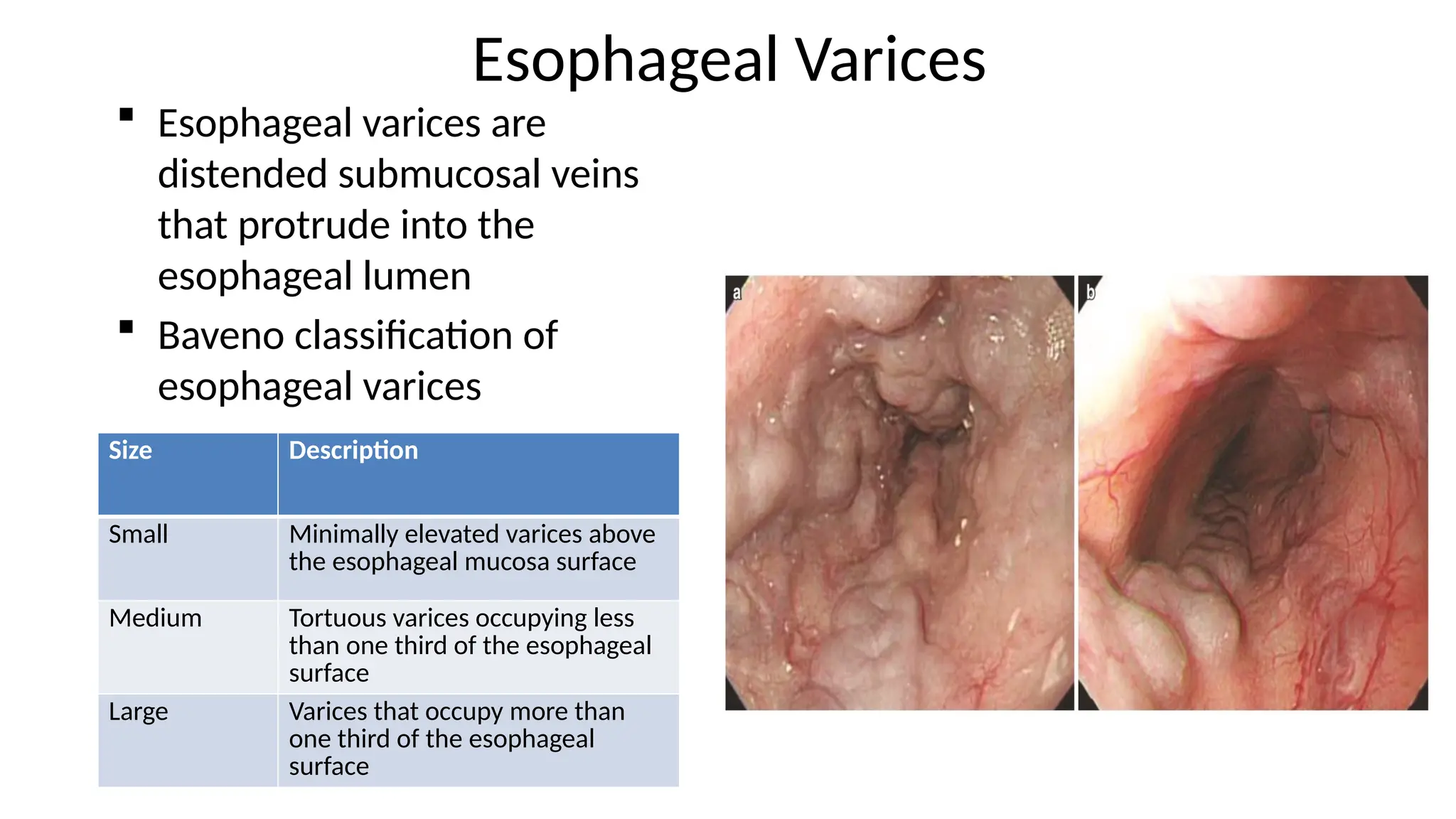 Esophageal Varices
 Esophageal varices are
distended submucosal veins
that protrude into the
esophageal lumen
 Baveno classification of
esophageal varices
Size Description
Small Minimally elevated varices above
the esophageal mucosa surface
Medium Tortuous varices occupying less
than one third of the esophageal
surface
Large Varices that occupy more than
one third of the esophageal
surface
 