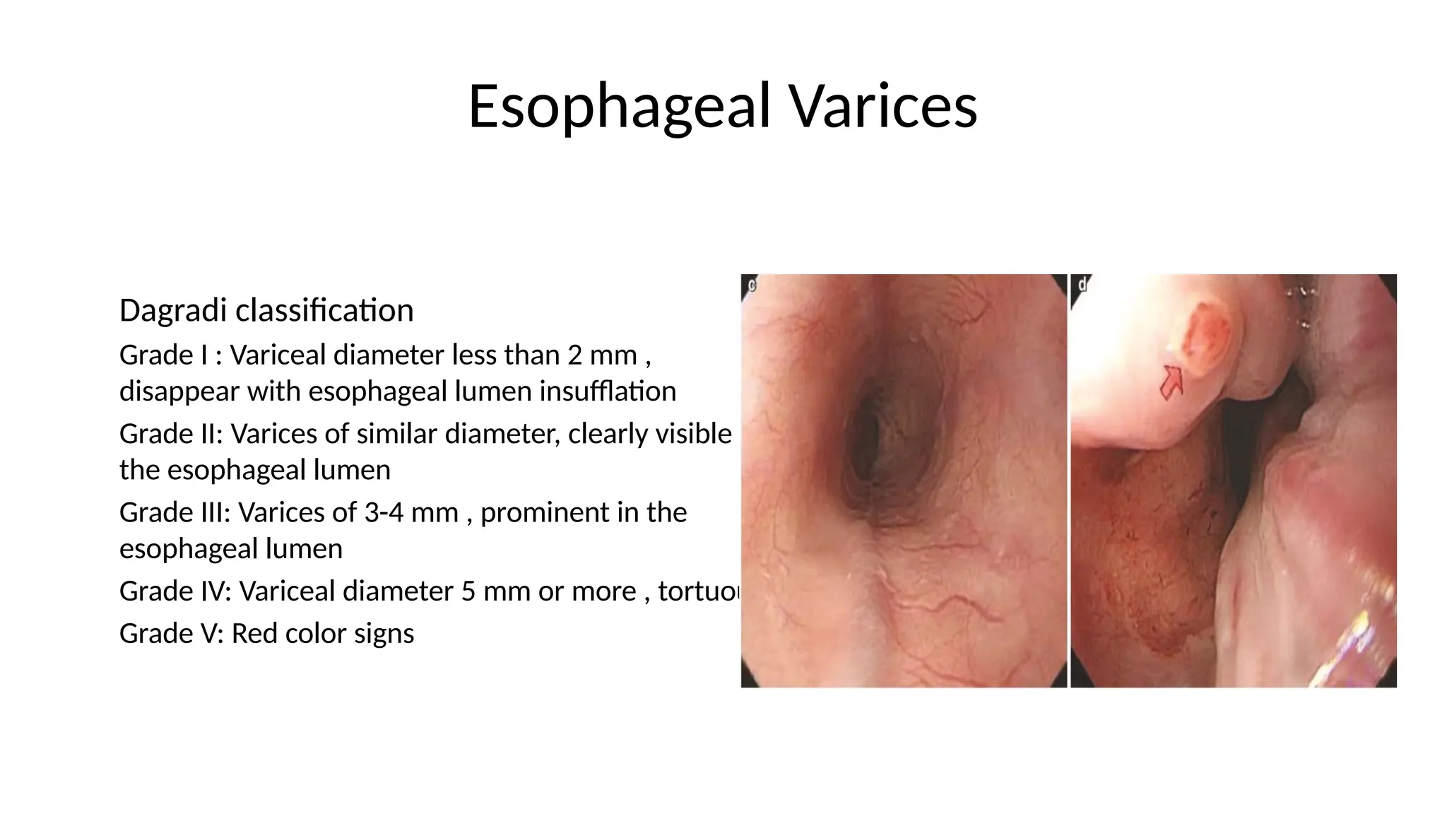 Esophageal Varices
Dagradi classification
Grade I : Variceal diameter less than 2 mm ,
disappear with esophageal lumen insufflation
Grade II: Varices of similar diameter, clearly visible in
the esophageal lumen
Grade III: Varices of 3-4 mm , prominent in the
esophageal lumen
Grade IV: Variceal diameter 5 mm or more , tortuous
Grade V: Red color signs
 